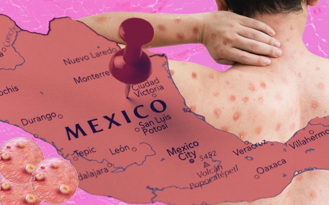 México en top 10 de países más afectados por Mpox, según DGE