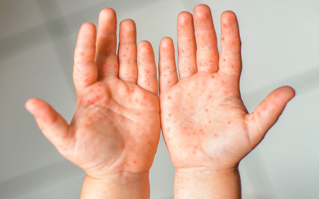 Con 362 casos de sarampión, Salud afirma que se ha contenido el brote en el país